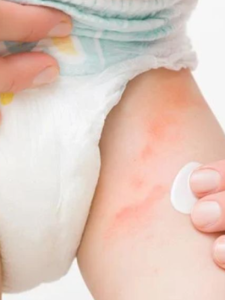 Diaper se hone vale rashesh par cream lagaye